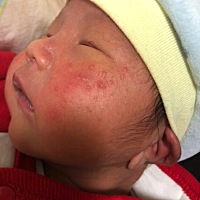 宝宝出生10多天，脸上就开始长这个痘痘，越来越严重，去医院做检查时，医生说是正常的，宝宝吃母乳后，...