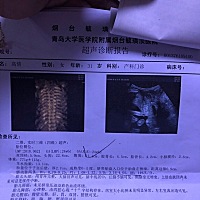 医生说我的宫颈短，容易早产，第二次复查，又没说短，纠结
