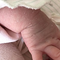 新生儿为什么会脱皮，有没人跟我们一样