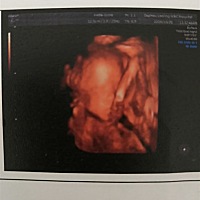 四维照宝宝很瘦，生下来也会很瘦吗，有同样的宝妈吗