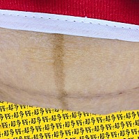 剖腹产的刀疤第10天了，还有3/2，做完月子😫，体重已经瘦了20斤，在瘦20斤可以和以前一样了，以前78�...