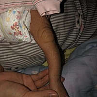 宝宝的小腿这么弯 是太瘦的原因吗？还是罗圈腿？