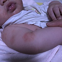 有宝妈知道这长的是什么吗？手臂肩膀一块一块的，脸上也有，干燥起皮。