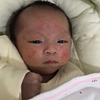 宝宝长了一脸的痘痘怎么办