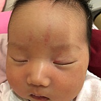 宝宝出生的时候额头上有两处红印，眼角有一处红印，医生说这是毛细血管扩张，会自动消失，可快满月...