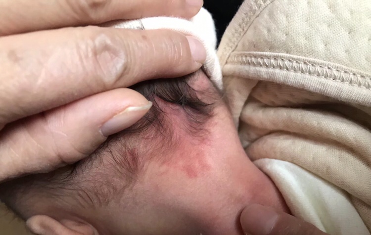宝宝刚出生后脑勺和两只眼皮上都有这种红色东西，这是什么？后面会消吗？