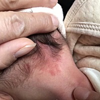 宝宝刚出生后脑勺和两只眼皮上都有这种红色东西，这是什么？后面会消吗？