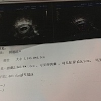 各位大佬们，帮我看看这个是小棉袄吗怀孕5周左右