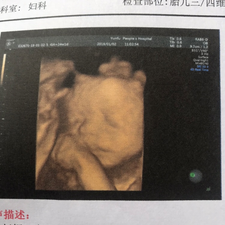 今天三维花了一个小时，小家伙趴着不让看脸出去走了半小时哈哈…医生划线部分其实问题大