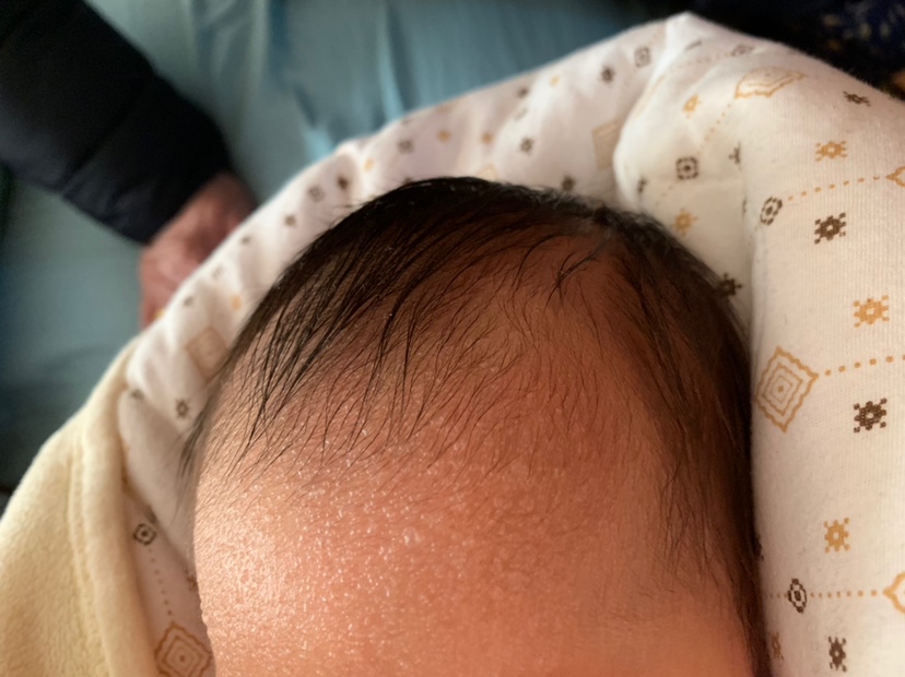 宝宝出生6天的时候额头上长了白色透明的小水泡，好几天了也没消，现在13天又不想用药，有什么好办法吗？