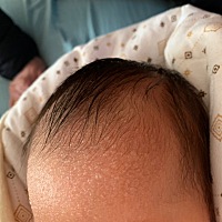 宝宝出生6天的时候额头上长了白色透明的小水泡，好几天了也没消，现在13天又不想用药，有什么好办法吗？