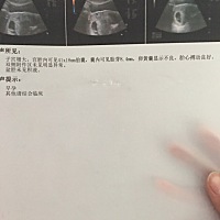 B超显示卵黄囊显示不良，有和我情况一样吗？7周1天