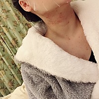 孕晚期长的，太难看了！谁能好办法祛痘，祛痘印？谢谢……