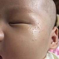 宝妈们看下我娃起的这是啥？是湿疹吗？？？还是热着了。