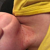 宝宝太胖了…脖子上一圈肉唔着…出了很多红点白头…之前用木瓜膏…感觉没有退下去，碘伏消毒又怕太...