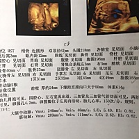 昨天的四维顺利通过，医生说下个月在做一次，我记得第一胎只做一次四维，怎么现在要做两次了，而且四维...