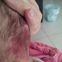 小宝1个月2天，昨天洗澡的时候发现后脑勺一大片红，月嫂也说早就看到🈶️了。应该是小宝生下来就带有...