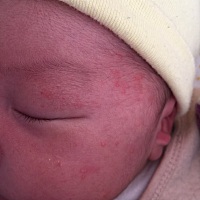 宝宝还没有满月，脸上长的到底是湿疹还是什么？用什么药好的快？