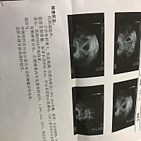 昨天出现褐色的血，晚上平躺睡了一晚真难受😣，今天一早去医院检查，在去的路上有流褐色的血，外加感...