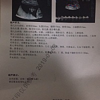 混合臀先露，严重吗？有没有什么其他异常