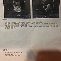 孕早期，检查出来左侧卵巢囊肿，会不会影响到宝宝，有没有和我相似经历的宝妈呀，好害怕喔