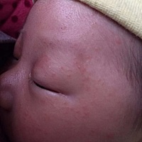 老公的外婆和婆婆总是给孩子包很厚抢着抱烤火边，脸上，后脑袋边，脖子，热的全是湿疹，屁股上也全...