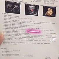 今天第一次四维，检查医生却说胎宝宝心脏上有两个亮点，怀疑是染色体有异常或者宝宝有先天性心脏病，但...