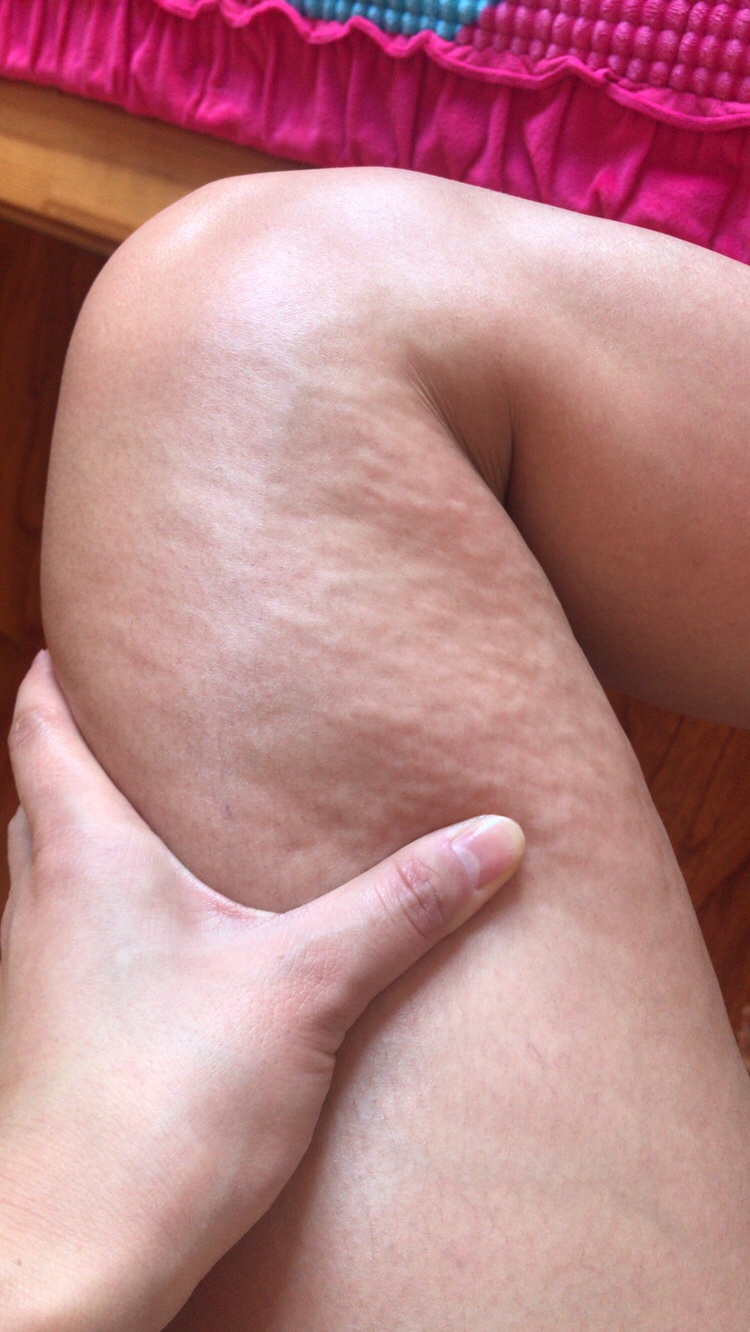 快30周了 这是要肿吗 腿一捏一使劲肉就变成这样 又知道的吗