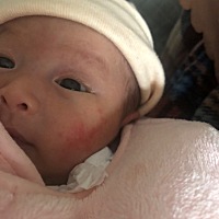 宝妈，孩子左边脸上长了一块红色的，不知道是不是湿疹