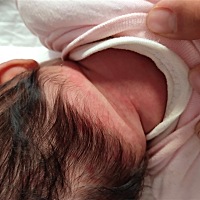 急急急！！！宝宝两个月 头后面和脖子交接处起这样的红斑 怎么回事？在线等！！