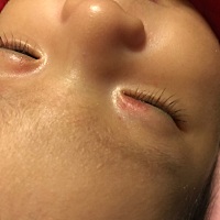 我家宝宝生下来眼角皮肤有红印，现在快两个月了还没下去，有没有同类宝宝，你们都怎么处理的？