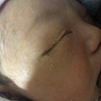 宝宝一只眼屎多，黄色粘稠怎么回事？医生说不是泪腺不通，就是空调开高了，我已经开了加湿器和19度空调...