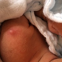 宝宝打疫苗的地方长了脓包，怎么会这样呢？