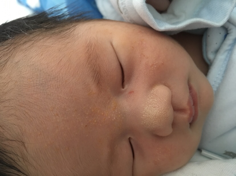 湿疹第十天了，以前是红红的，现在变成白白的一粒一粒的，你们的湿疹都这样吗？感觉这个一粒一粒好难消掉啊