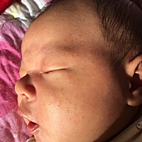 宝宝脸上这是什么 有什么办法