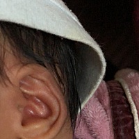 小孩出生12天的时候戴的帽子怕掉给折了下戴得紧了把耳朵上边缘软骨给压扁了，能恢复么，挂了儿科医生说...