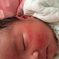 着急，有没有妈妈家的宝宝脸上也长疙瘩的，我家宝两天脸上长了很多疙瘩，耳朵上也有，其他地方没有...