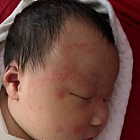 各位宝妈，知道宝宝脸上发的是湿疹吗