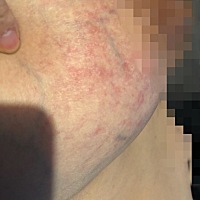 胸部上面长红色凸起点点…很痒…一片一片的…目前在用炉甘石…感觉没有退下去…有没有同样情况的宝妈。