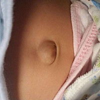宝宝肚脐眼这个样子有谁懂的，知道是怎么回事吗？