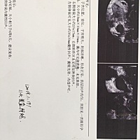 快六周，月初例假没来就觉得是怀孕了，用验孕棒测了就是早孕，因为前期感冒一直输水吃药，怕影响胎儿，...