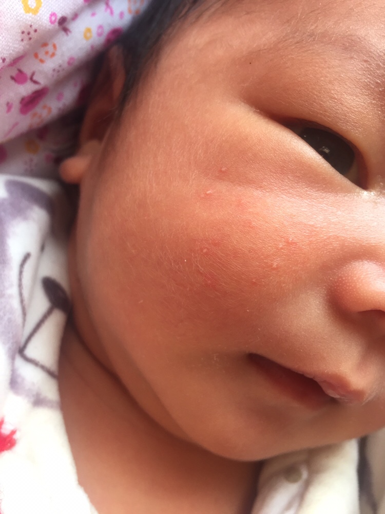 这个是不是湿疹，怎样消除