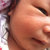 急求解 这个是不是湿疹，怎样消除