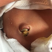宝宝出生10天了，肚脐这样看着好担心，有宝宝出生十天肚脐还是这样的吗？