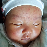 各位宝妈，宝宝30天，脸上长了好多这样的小痘痘，越来越多了，宝宝晚上睡不好老是扭来扭去，这是什么原...
