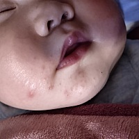 3个月宝宝 脸上长这个 1礼拜多了还没好  有知道这是什么嘛？求问