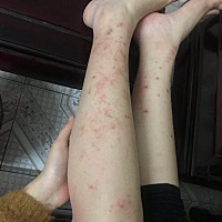 有没有宝妈怀孕然后小腿痒得，之前怀老大也是这样。他们都说这是胎毒。因为吃上火的东西孩子没有吸收。...