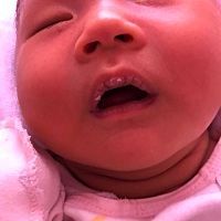 我家宝宝快满月了，嘴巴还是这样，正常吗？是我吃东西不注意吗，母乳喂养