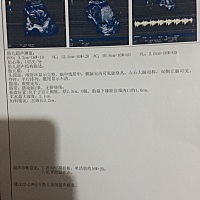 胎盘位置有点偏低，有点小担心，希望能够长上来。不知道是男还是女，有会看的看看是什么