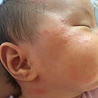 有经验的宝妈帮忙看一下，孩子脸上起的是什么，都起来20多天了下不去，头发里面也有，后背也有